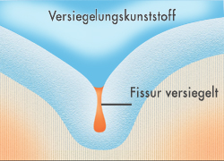 Wirkungsweise der Fissurenversiegelung