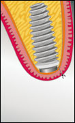 Das Implantat heilt nach der Eingliederung ohne Belastung ein.