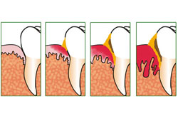 Gingivitis