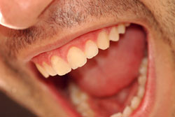 Entstehung einer Gingivitis